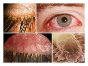 Síntomas da presenza de parasitos baixo a pel humana